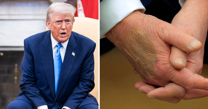 White House responds after Donald Trump sports nasty bruise