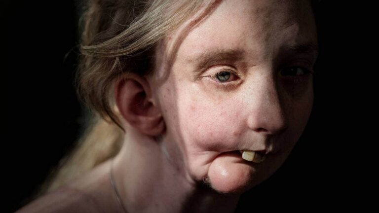 Despite the fact that the ACC has been refusing her claim for nine months, she is still waiting for the life-changing procedure…