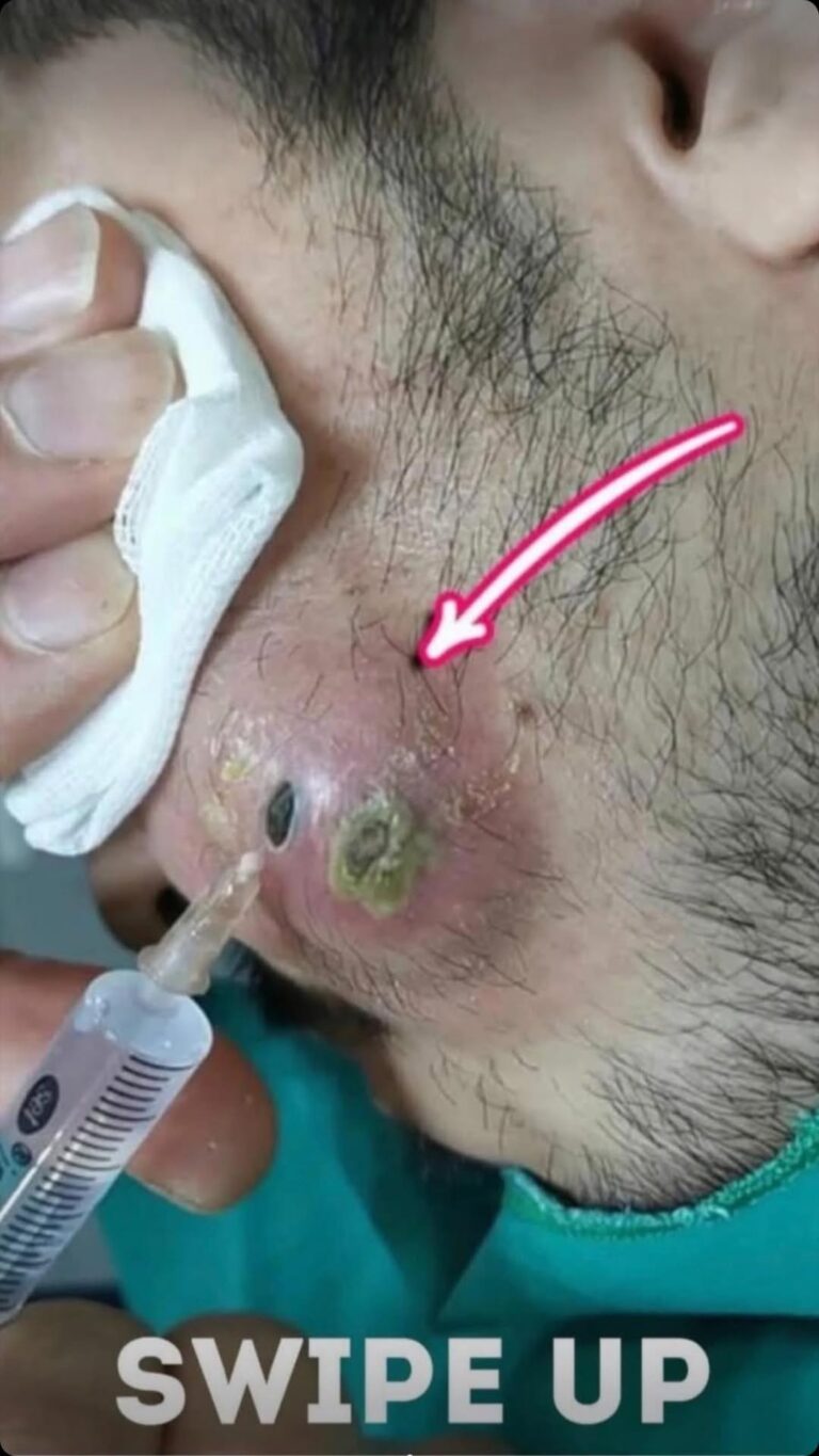 Please do not look at these 9 pictures If You Have A Body Acne