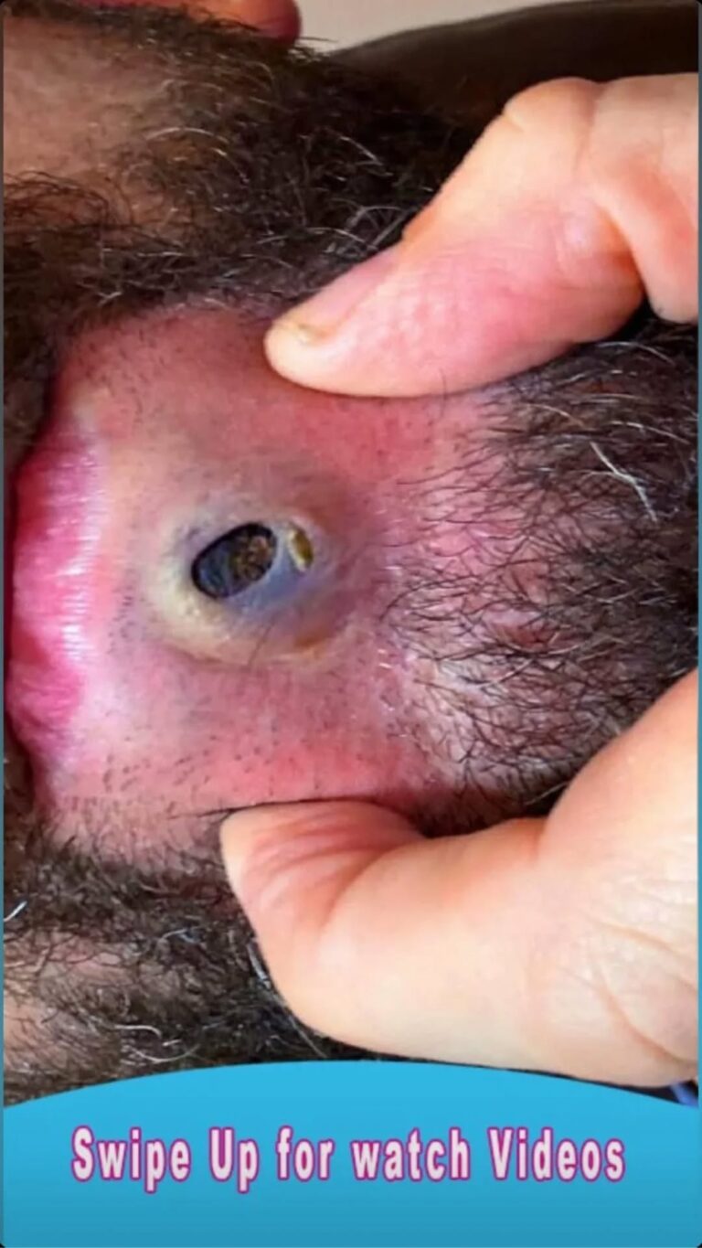 10 Bug Bites Anyone Should Be Able to Identify