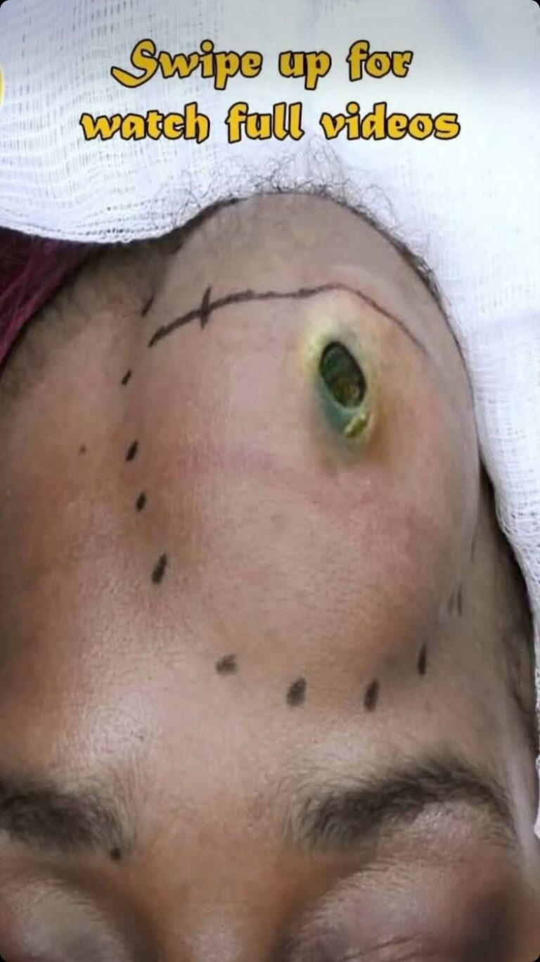 Their acne is severe