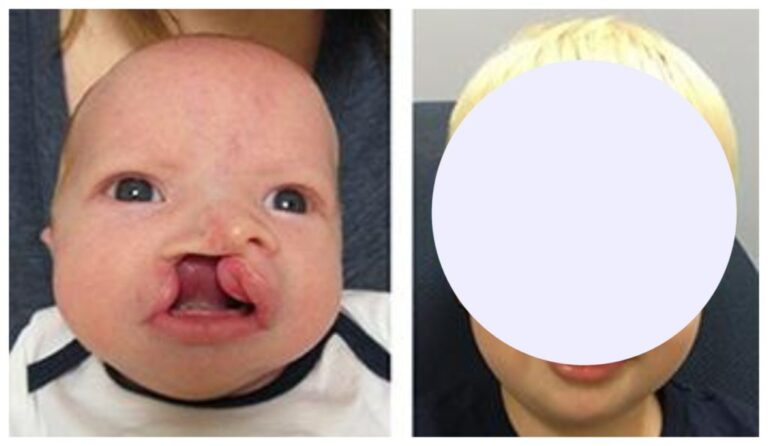 This baby’s facial transformation is amazing… He grew up and became a handsome boy…
