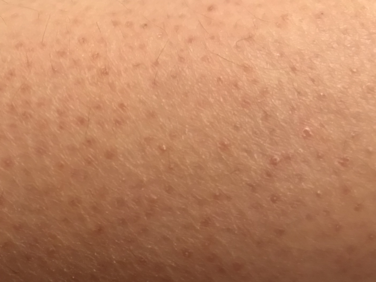 The Cause Of The Odd White Pimples On Your Your Body