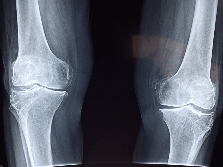 Doctor Breaks Down Bizarre Theory About People Who’ve Never Broken A Bone