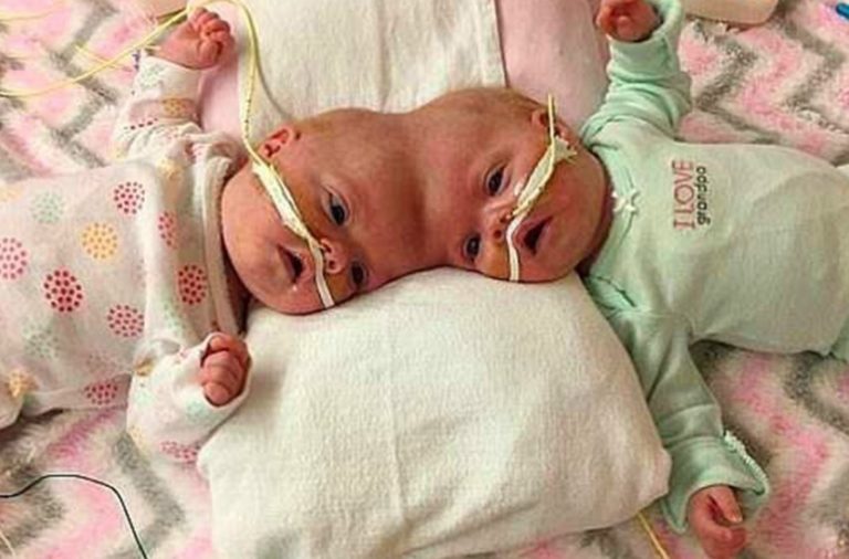 Siamese twins’ appearance and way of life have changed drastically since they separated five years ago….