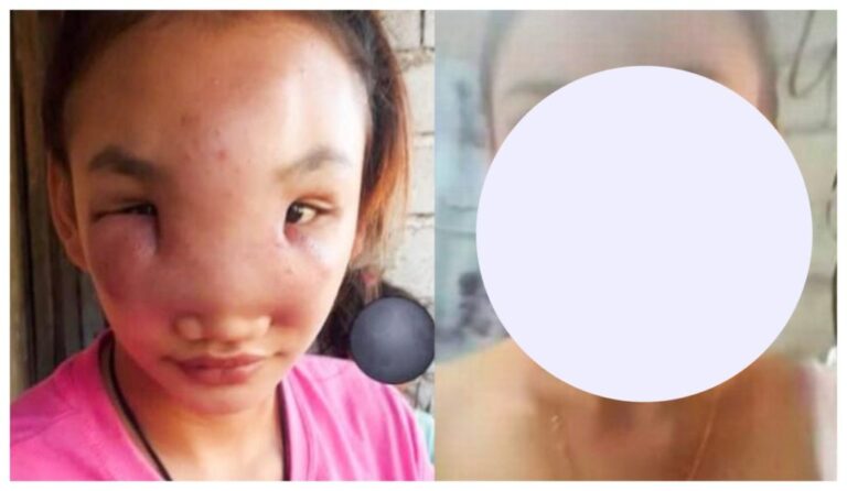A spot on the nose of a girl who is 17 years old causes her to lose her vision…