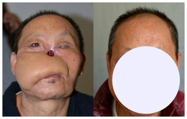 Tsagay’s struggle towards independence is handled by his new nose…