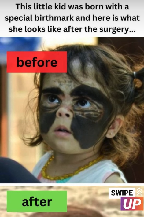 ST, This little kid was born with a special birthmark and here is what she looks like after the surgery…