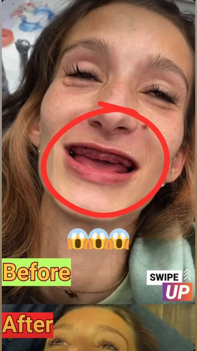 Former drug addict transformed with drastic $38K smile makeover