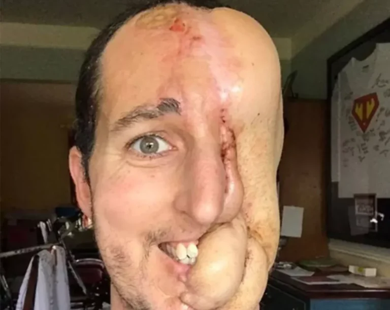 A man who lost half of his face has got a new life chance… See how he looks now below…
